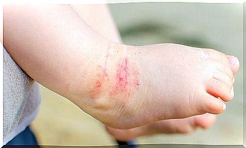 Atopic eczema: 15 great tips to get rid of it