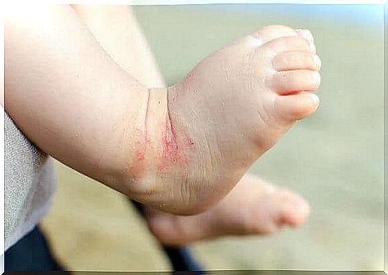 Eczema in children: How to prevent outbreaks.