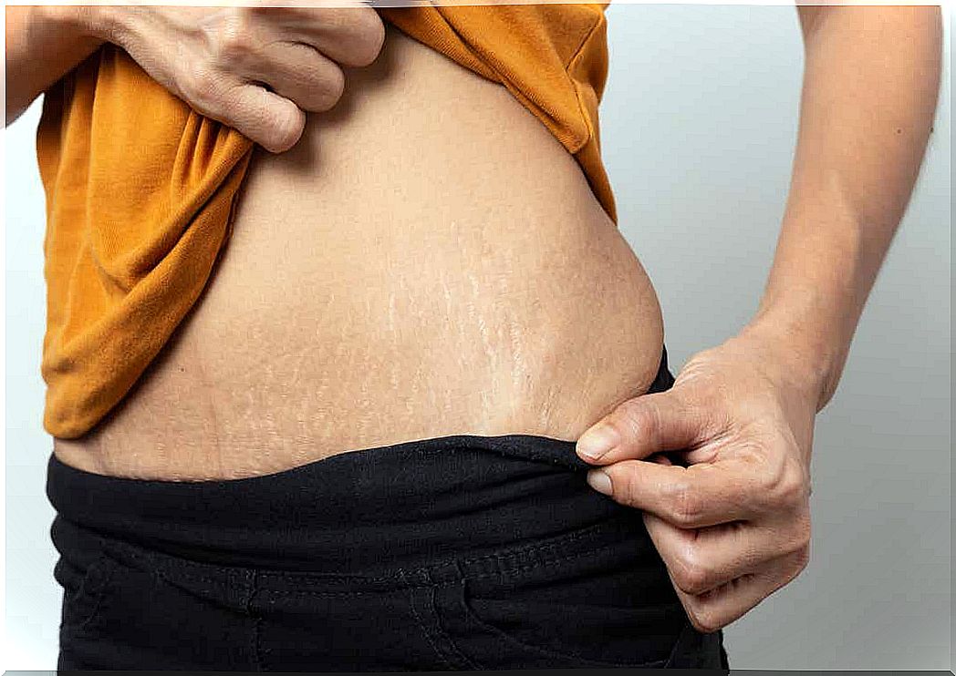 A woman with stretch marks on her stomach