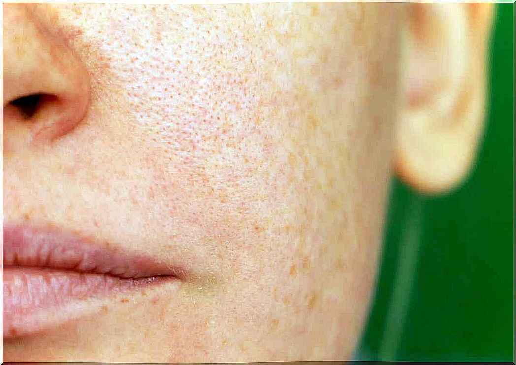 A woman with melasma on her face