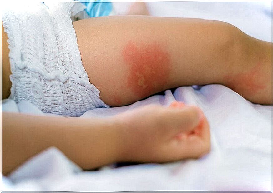 How To Prevent And Treat Bleeding Eczema