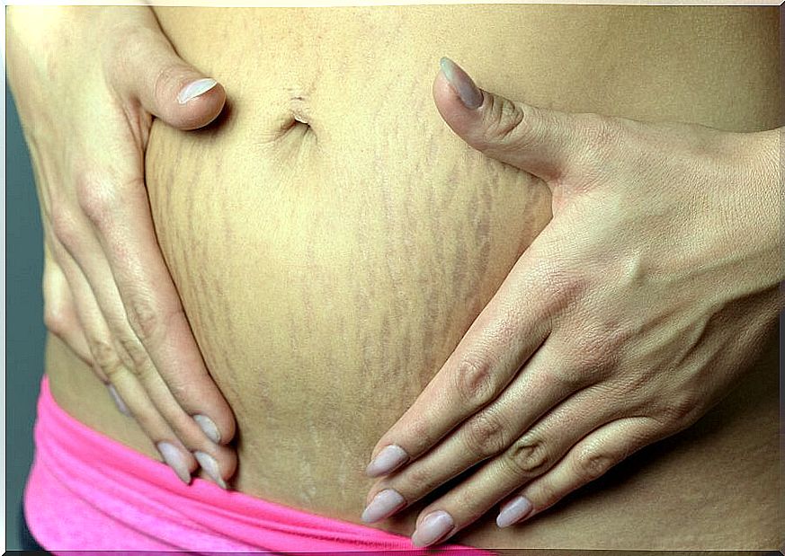 How To Remove Stretch Marks During Pregnancy