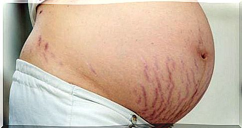 Stretch marks