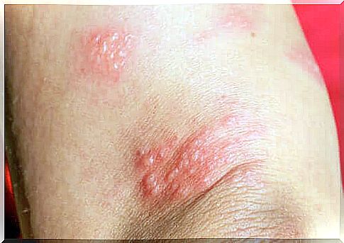 Pregnancy pemphigoid during pregnancy