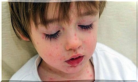 Scarlet Fever: What You Need To Know About It